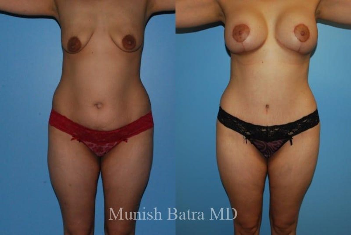 Mommy Makeover Before & After Gallery - Patient 217624 - Image 1
