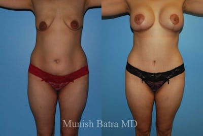 Mommy Makeover Before & After Gallery - Patient 219999 - Image 1