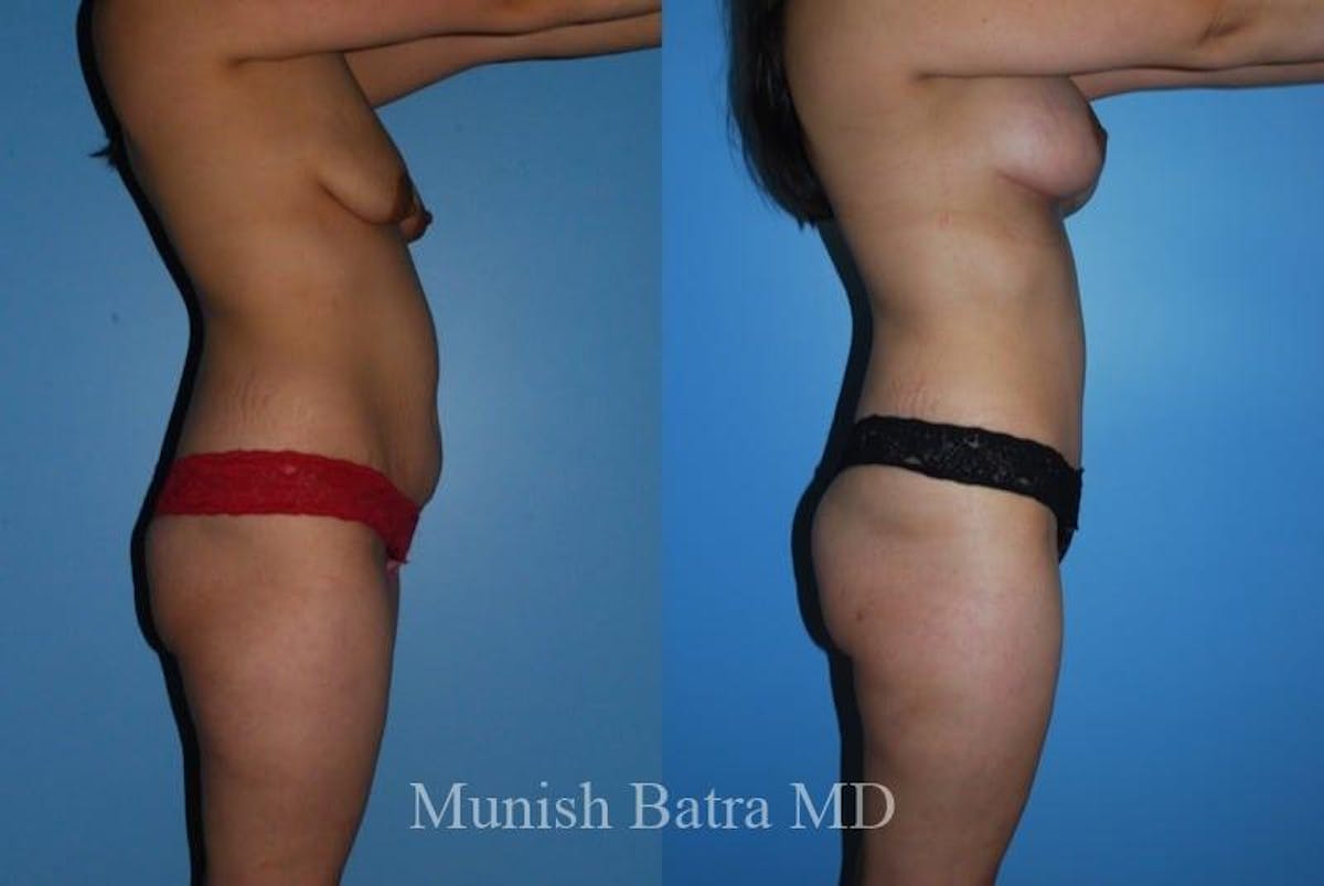 Mommy Makeover Before & After Gallery - Patient 217624 - Image 2