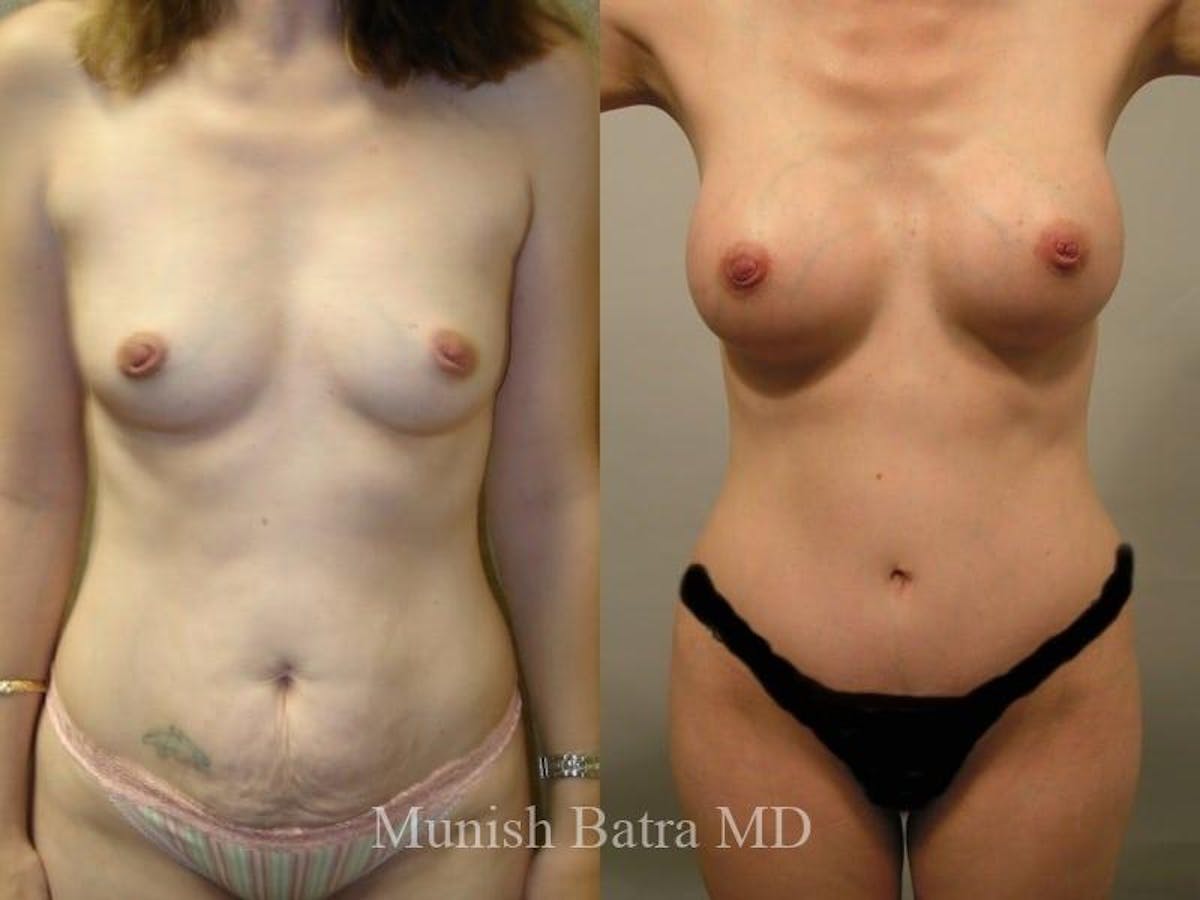 Mommy Makeover Before & After Gallery - Patient 534886 - Image 1
