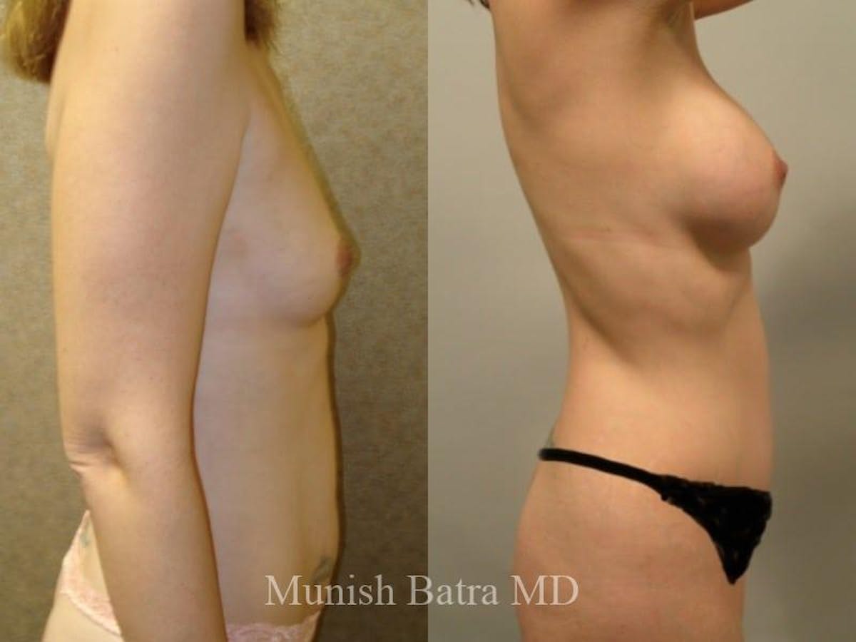 Mommy Makeover Before & After Gallery - Patient 534886 - Image 2