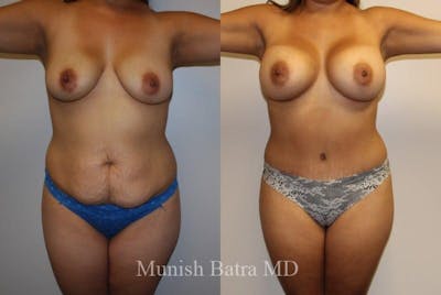 Mommy Makeover Before & After Gallery - Patient 278747 - Image 1