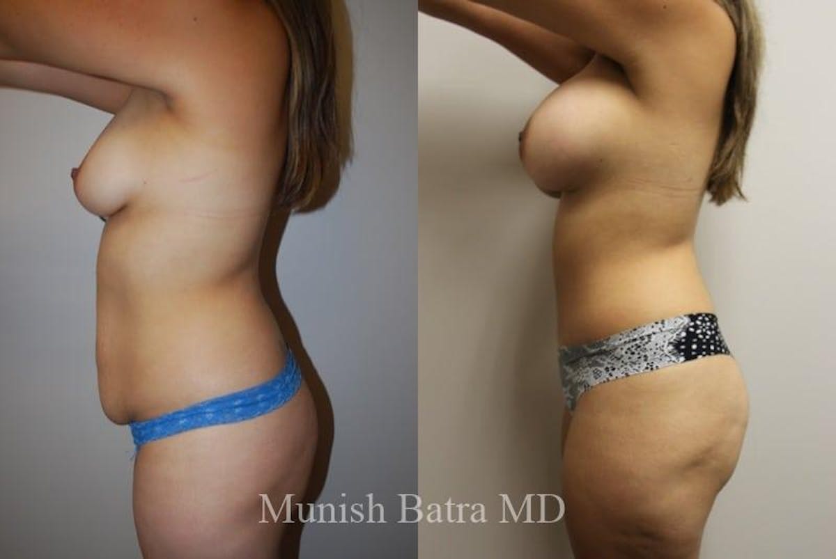 Mommy Makeover Before & After Gallery - Patient 278747 - Image 2