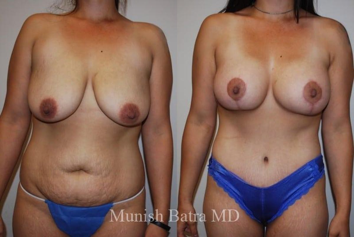 Mommy Makeover Before & After Gallery - Patient 178910 - Image 1