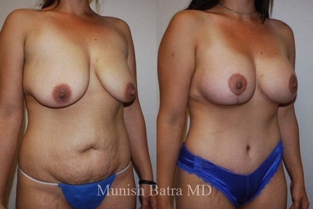 Mommy Makeover Before & After Gallery - Patient 178910 - Image 2