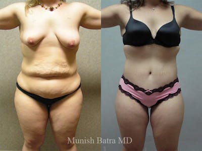 Tummy Tuck Before & After Gallery - Patient 202762 - Image 1