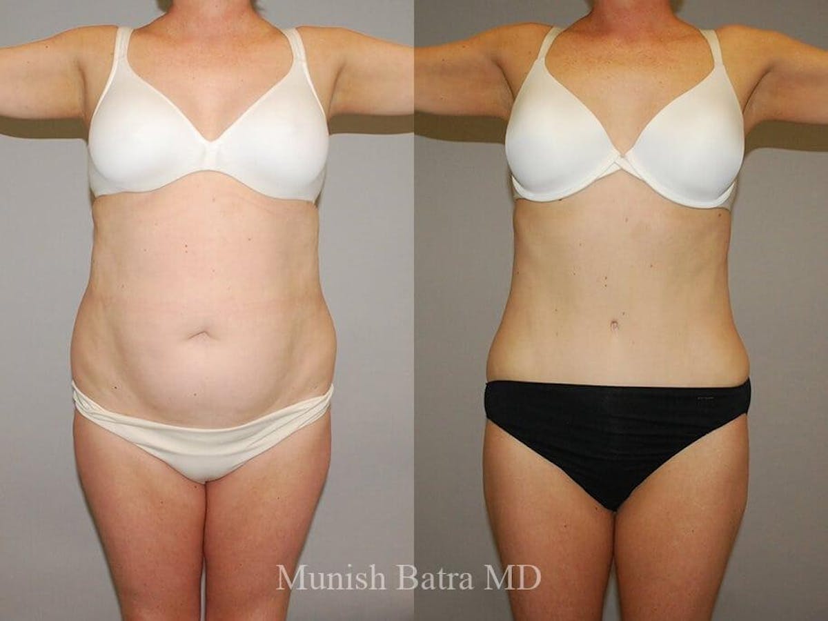 Tummy Tuck Before & After Gallery - Patient 171978 - Image 1