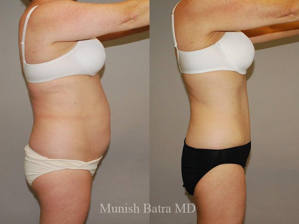 Tummy Tuck Before & After Gallery - Patient 171978 - Image 2