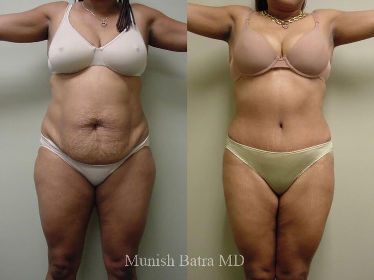 Tummy Tuck Before & After Gallery - Patient 414655 - Image 1