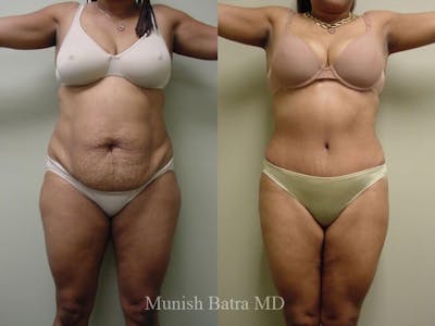 Tummy Tuck Before & After Gallery - Patient 414655 - Image 1