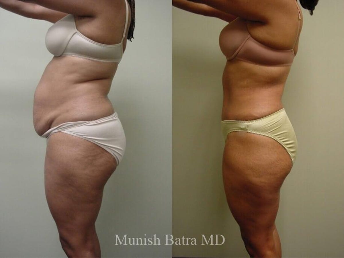 Tummy Tuck Before & After Gallery - Patient 414655 - Image 2