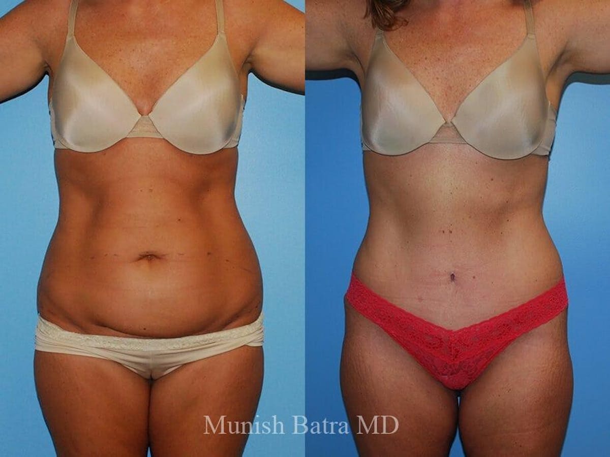 Tummy Tuck Before & After Gallery - Patient 170019 - Image 1