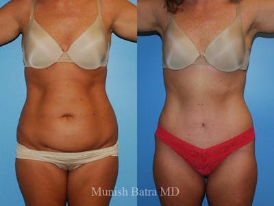 Tummy Tuck Before & After Gallery - Patient 170019 - Image 1