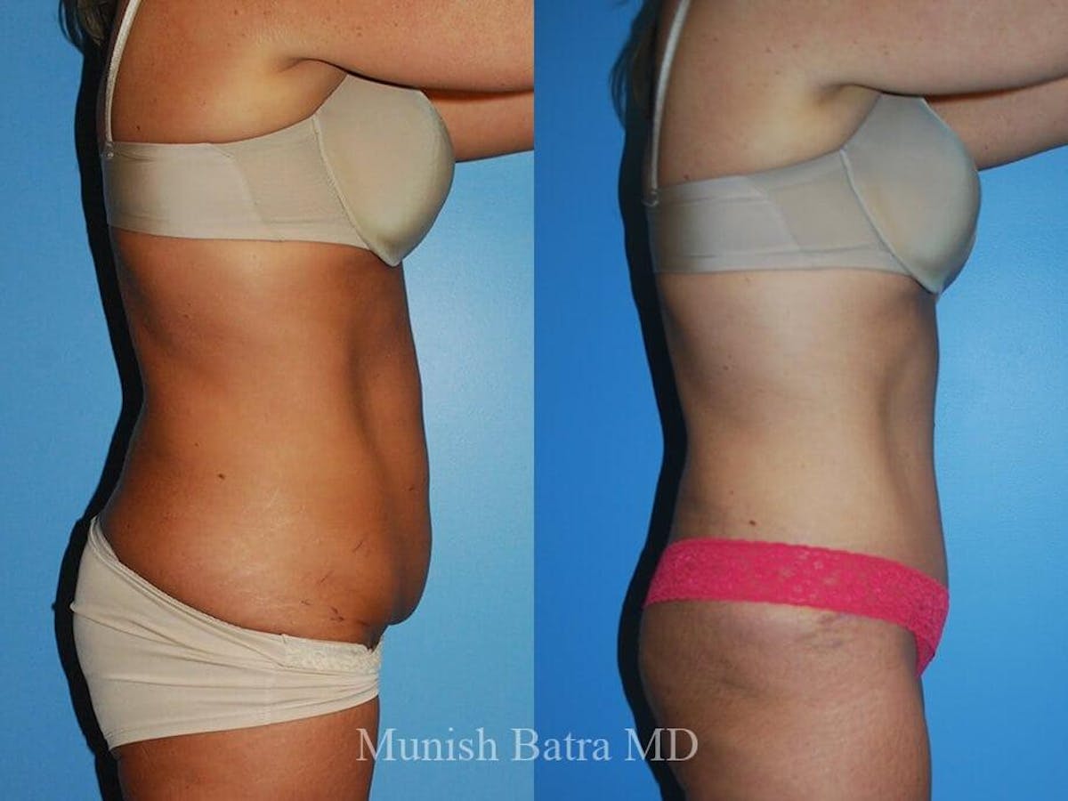 Tummy Tuck Before & After Gallery - Patient 170019 - Image 2