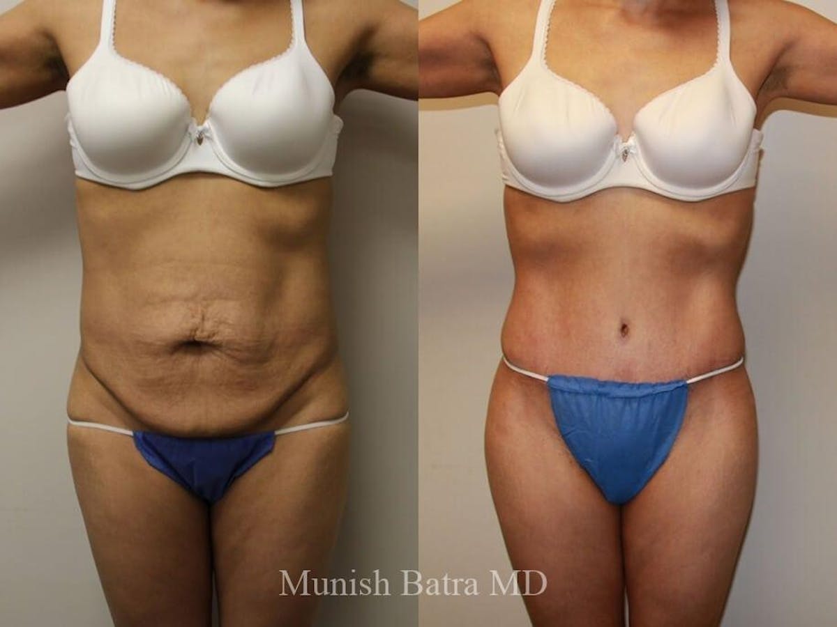 Tummy Tuck Before & After Gallery - Patient 351033 - Image 1