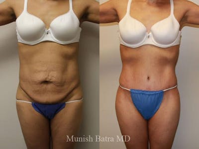 Tummy Tuck Before & After Gallery - Patient 351033 - Image 1