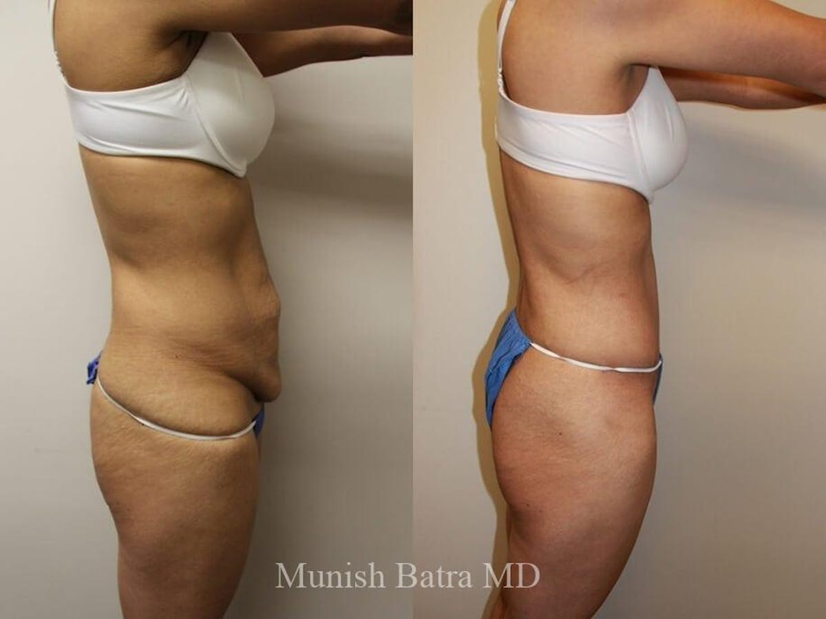 Tummy Tuck Before & After Gallery - Patient 351033 - Image 2