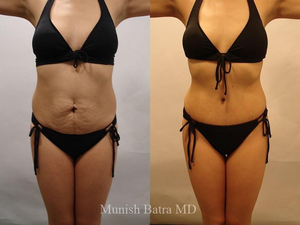 Tummy Tuck Before & After Gallery - Patient 320646 - Image 1