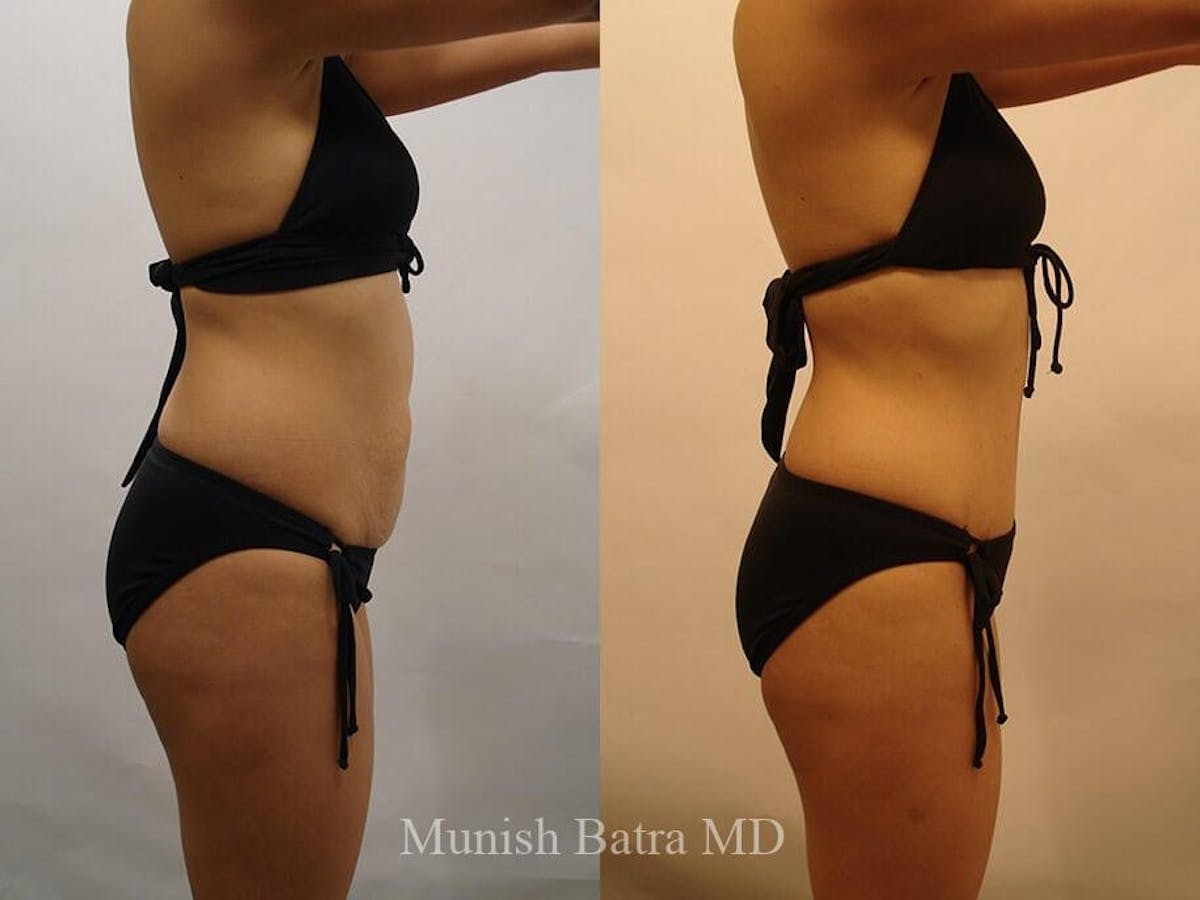 Tummy Tuck Before & After Gallery - Patient 320646 - Image 2