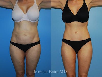 Tummy Tuck Before & After Gallery - Patient 234389 - Image 1