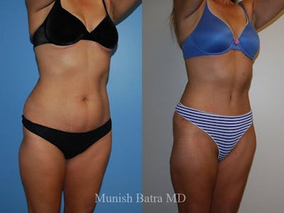 Tummy Tuck Before & After Gallery - Patient 131617 - Image 1