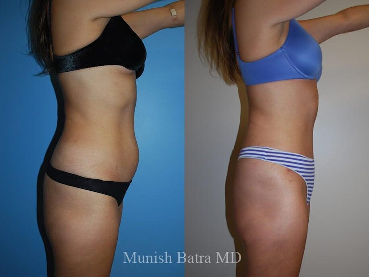 Tummy Tuck Before & After Gallery - Patient 131617 - Image 2