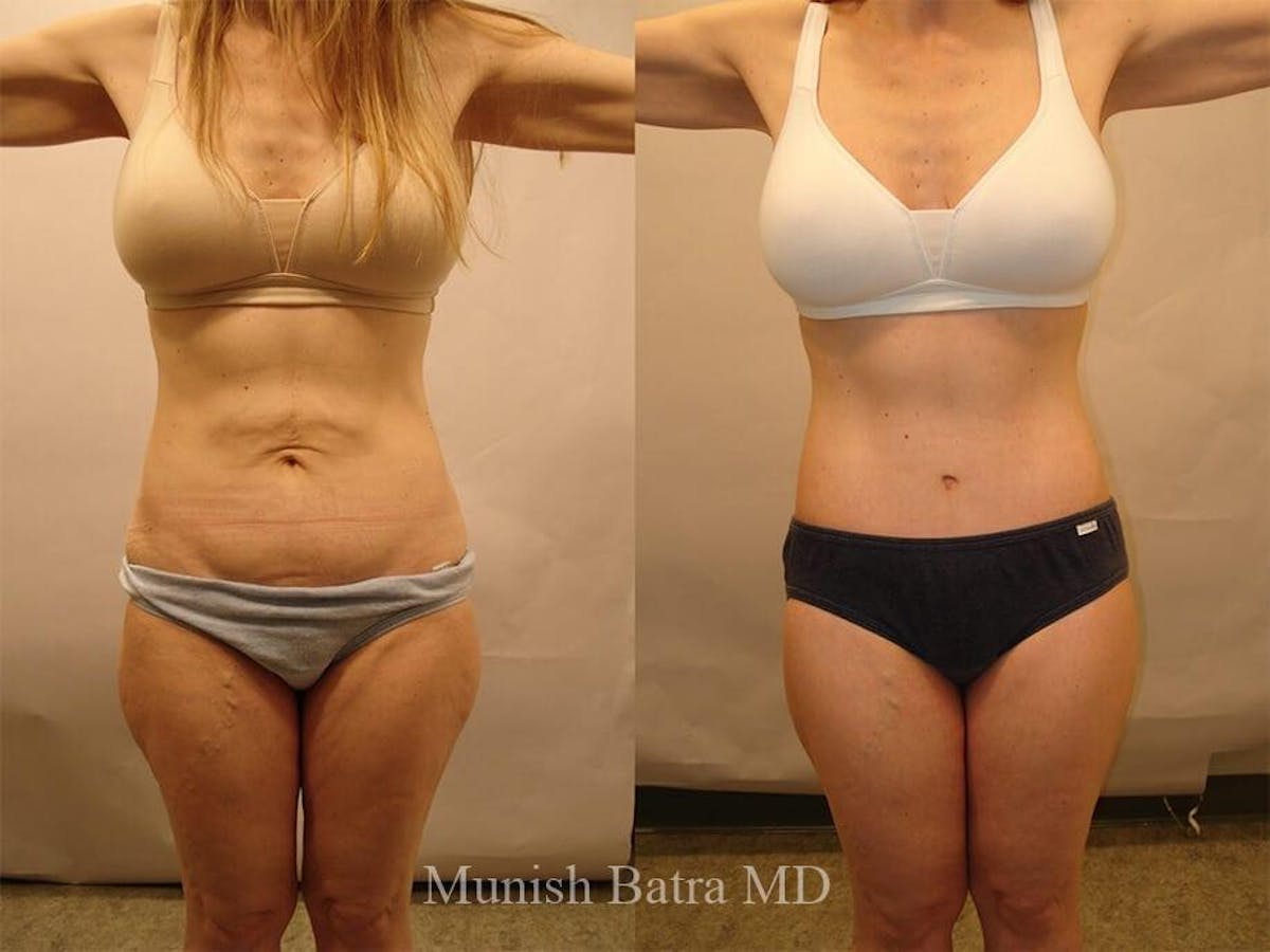Tummy Tuck Before & After Gallery - Patient 217407 - Image 1