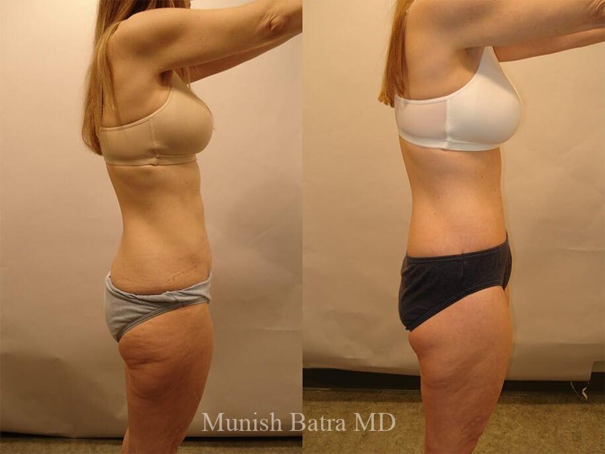 Tummy Tuck Before & After Gallery - Patient 217407 - Image 2