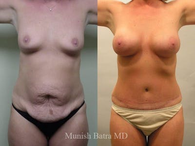 Tummy Tuck Before & After Gallery - Patient 163314 - Image 1