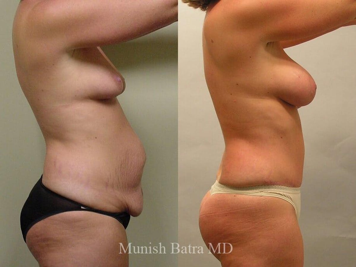 Tummy Tuck Before & After Gallery - Patient 163314 - Image 2