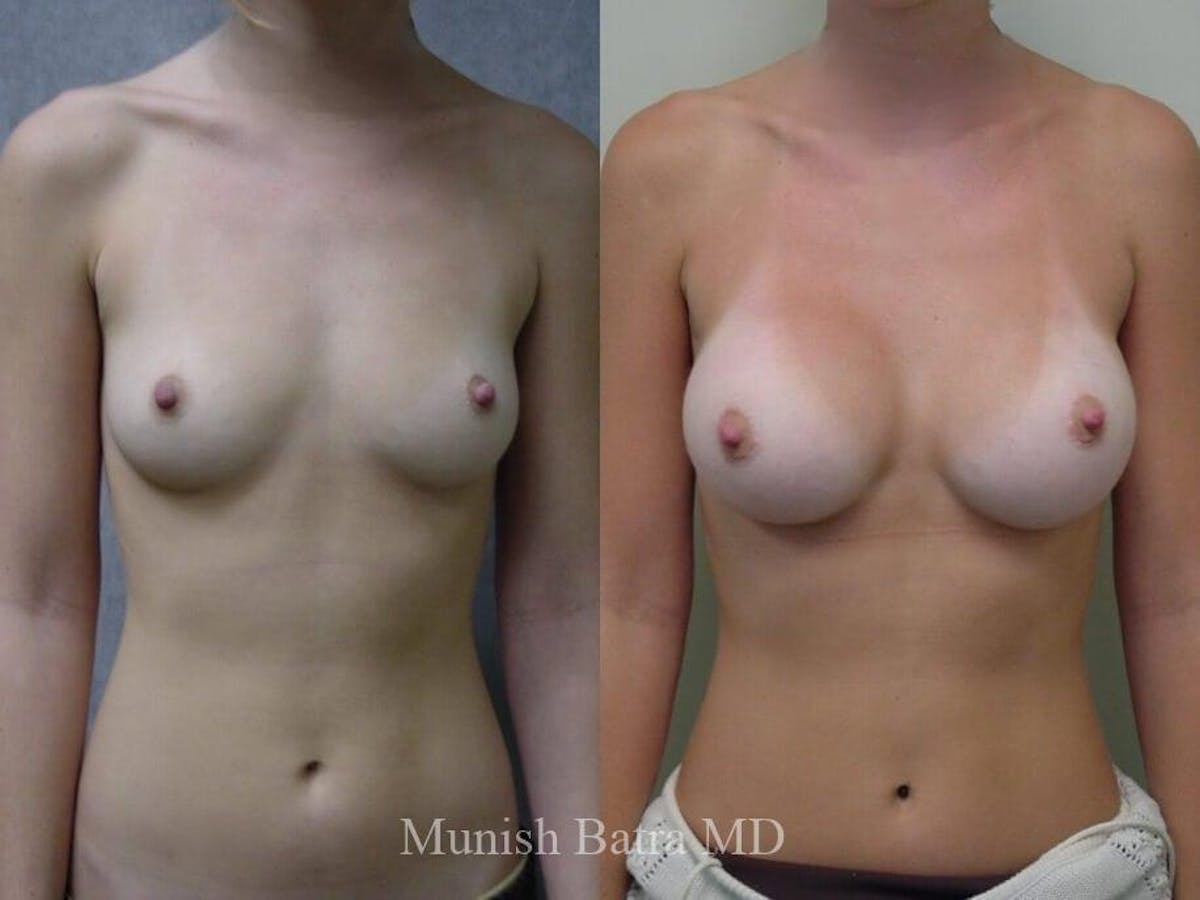 Breast Augmentation Before & After Gallery - Patient 263985 - Image 1