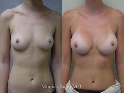 Breast Augmentation Before & After Gallery - Patient 263985 - Image 1