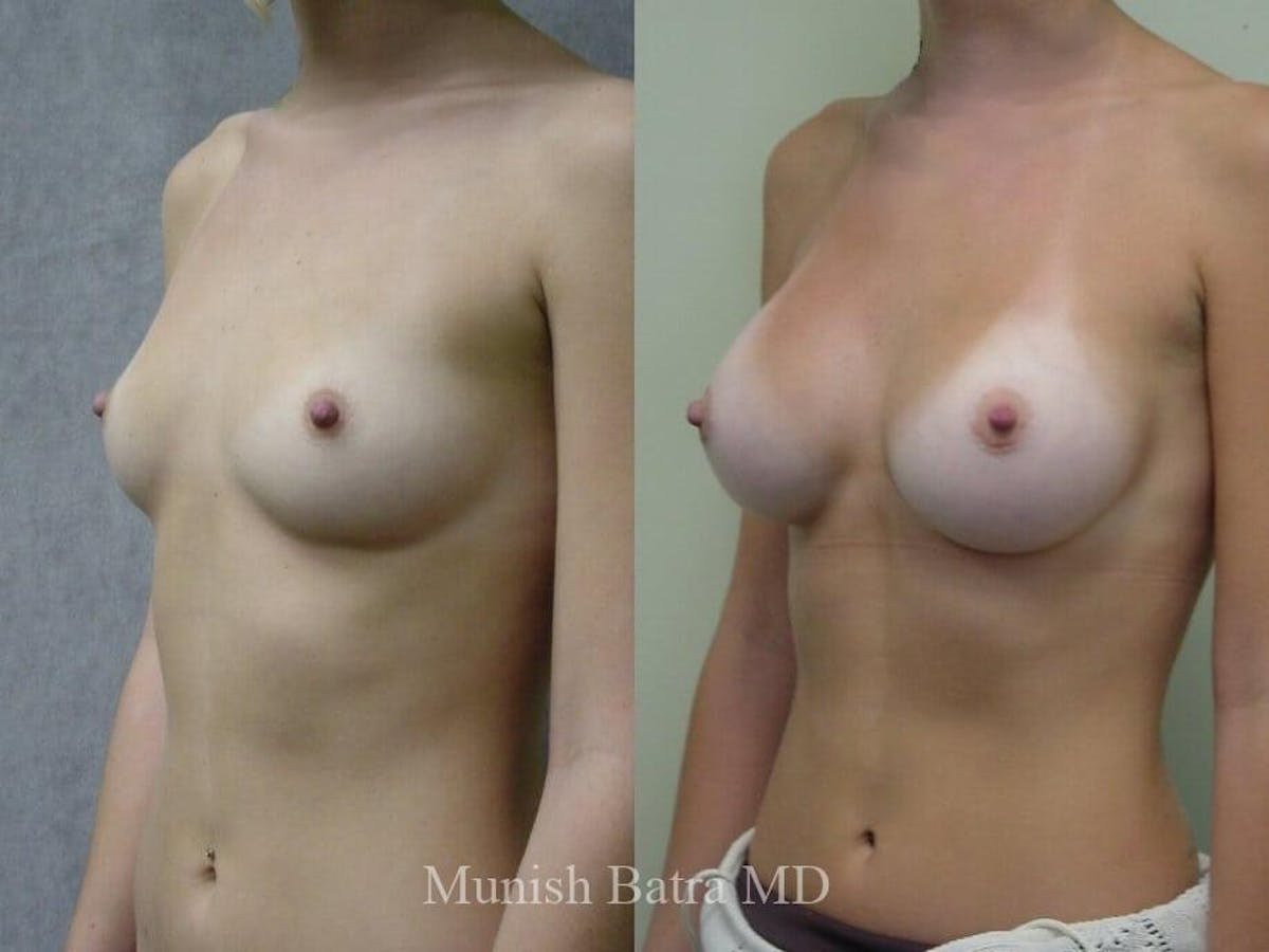 Breast Augmentation Before & After Gallery - Patient 263985 - Image 2