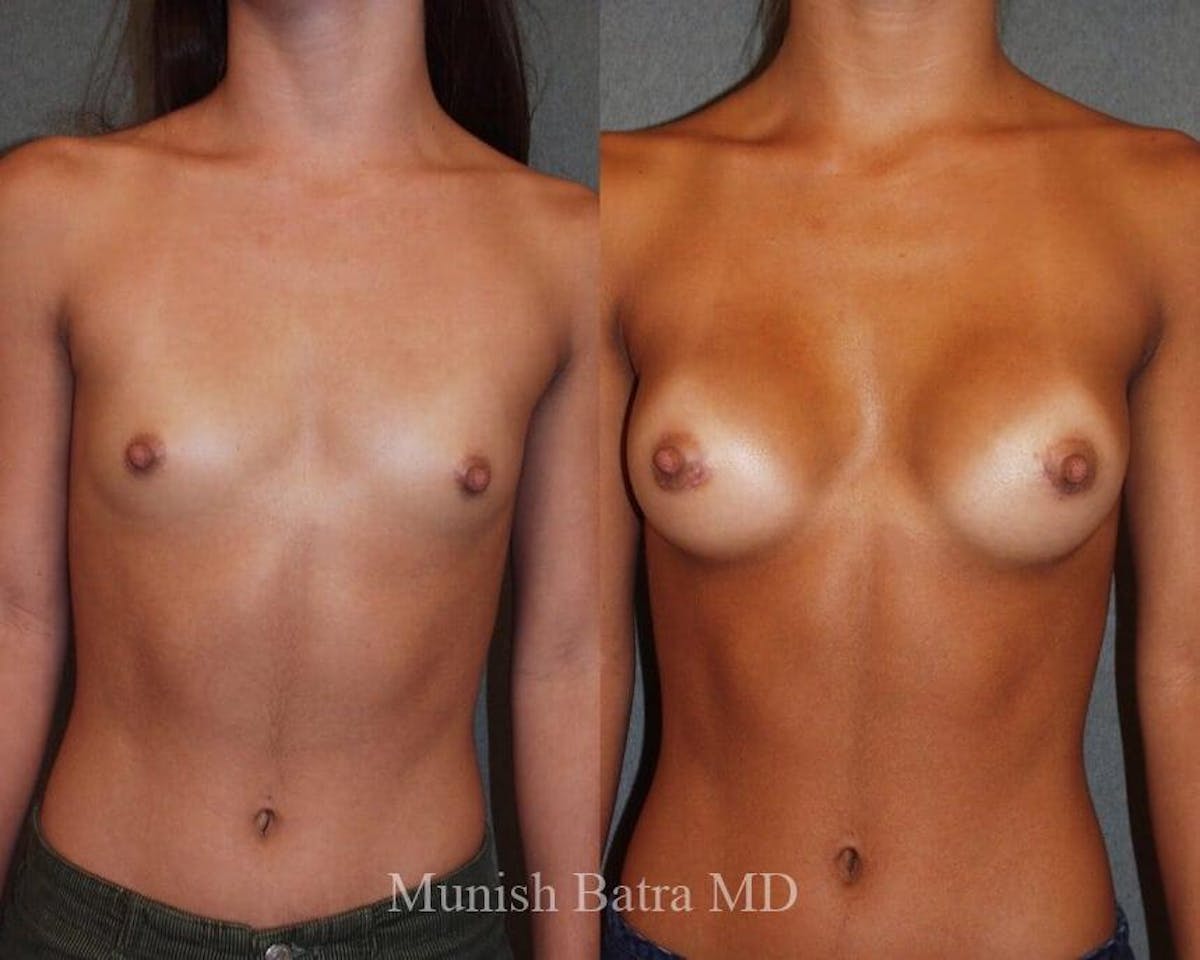 Breast Augmentation Before & After Gallery - Patient 233279 - Image 1