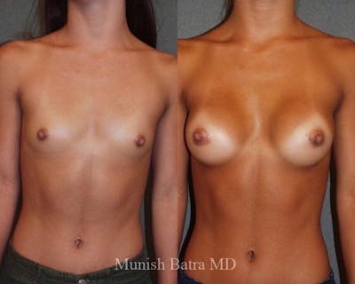 Breast Augmentation Before & After Gallery - Patient 233279 - Image 1