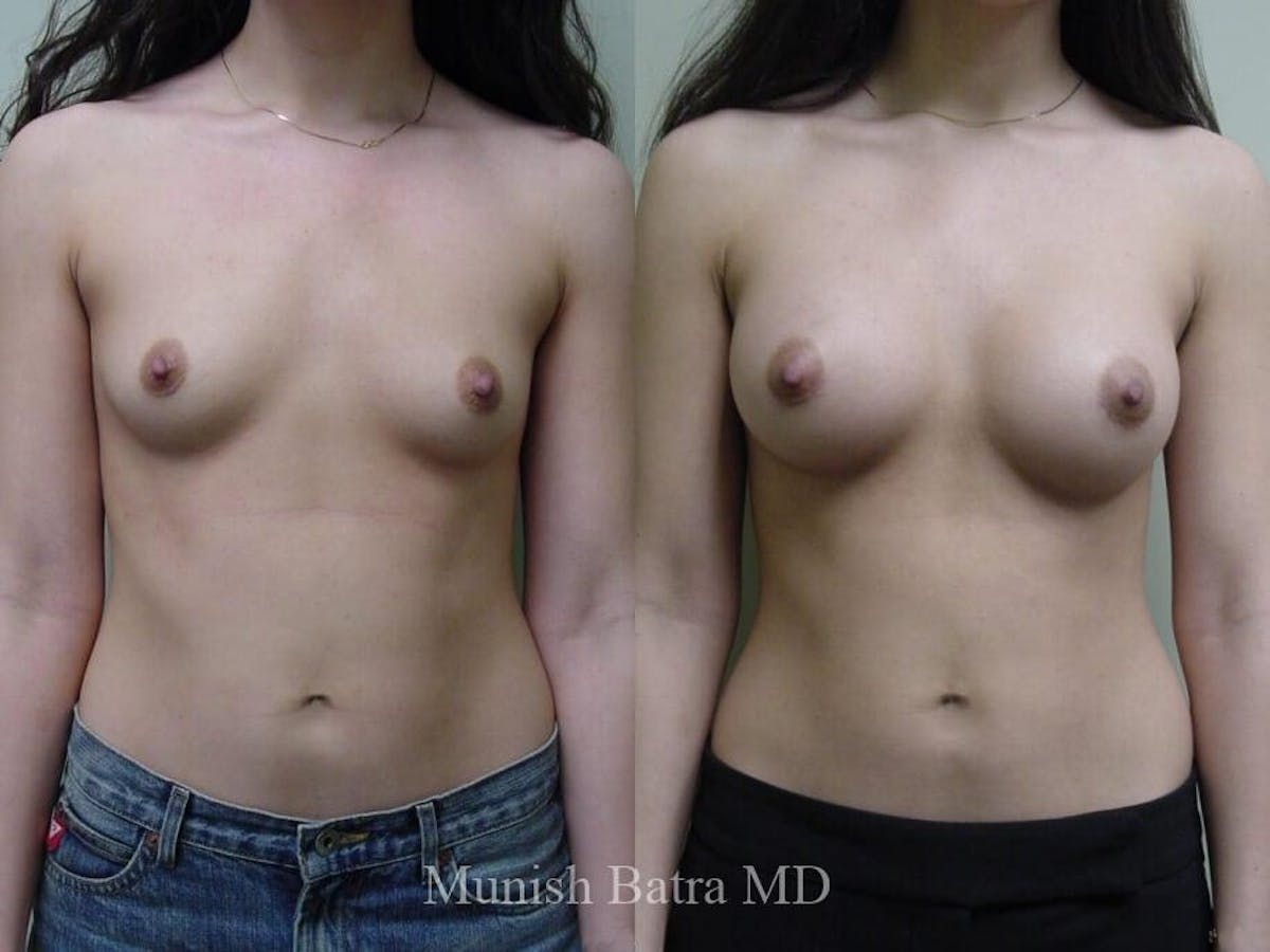 Breast Augmentation Before & After Gallery - Patient 807580 - Image 1