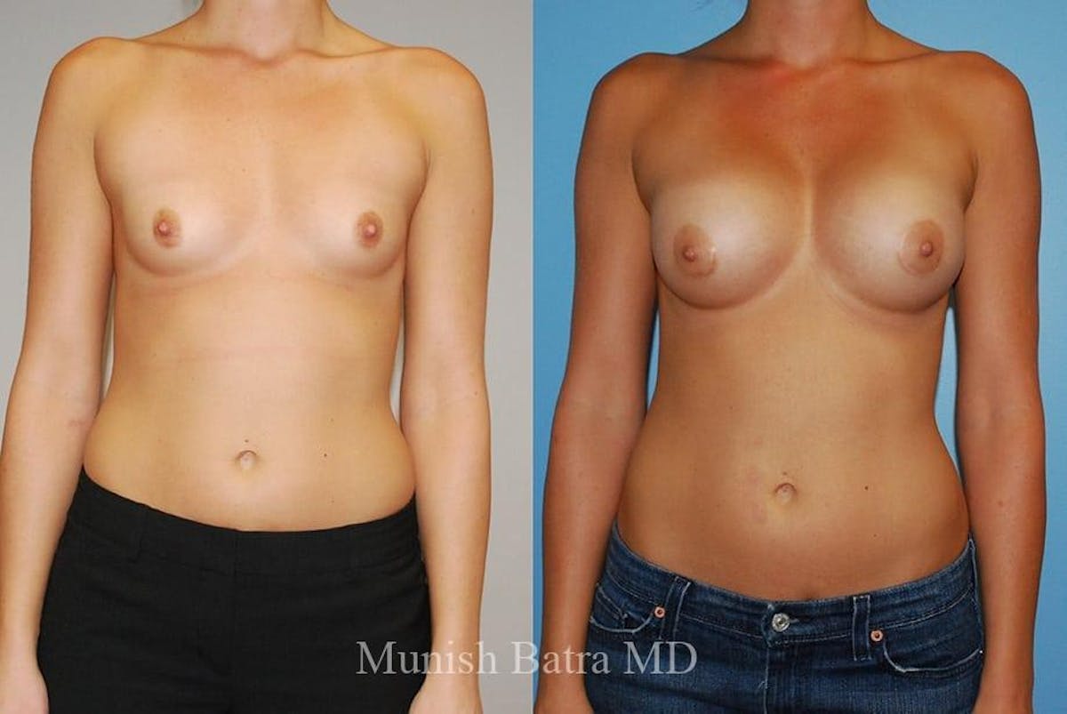 Breast Augmentation Before & After Gallery - Patient 182321 - Image 1