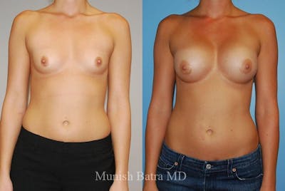 Breast Augmentation Before & After Gallery - Patient 182321 - Image 1
