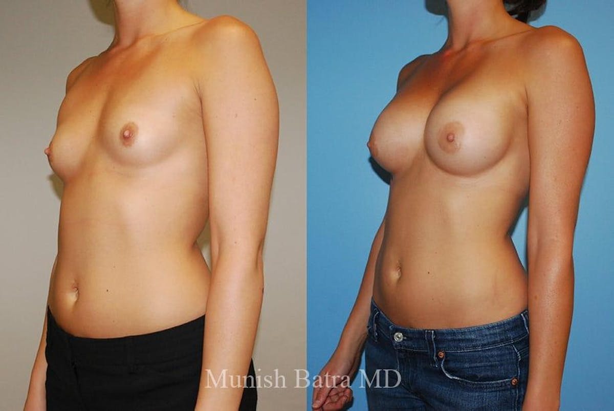 Breast Augmentation Before & After Gallery - Patient 182321 - Image 2