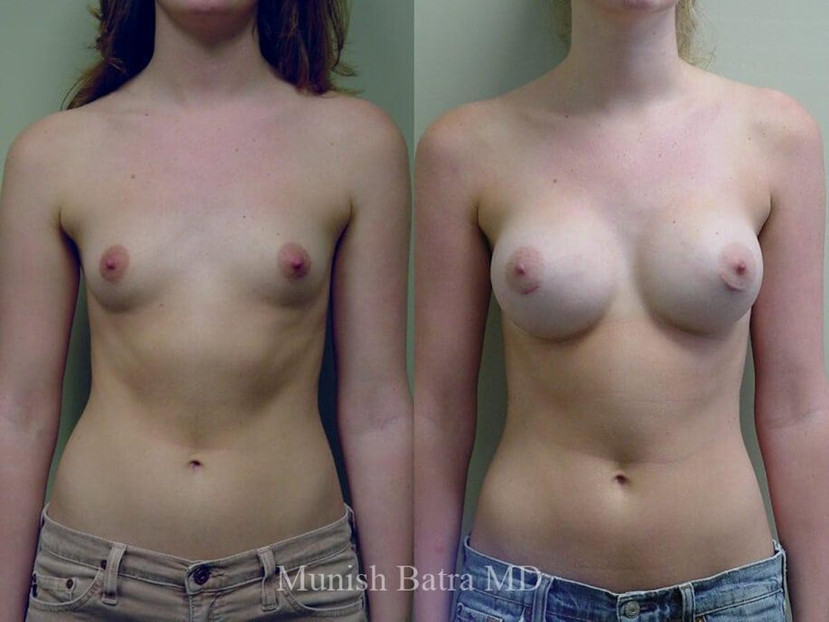 Breast Augmentation Before & After Gallery - Patient 224295 - Image 1