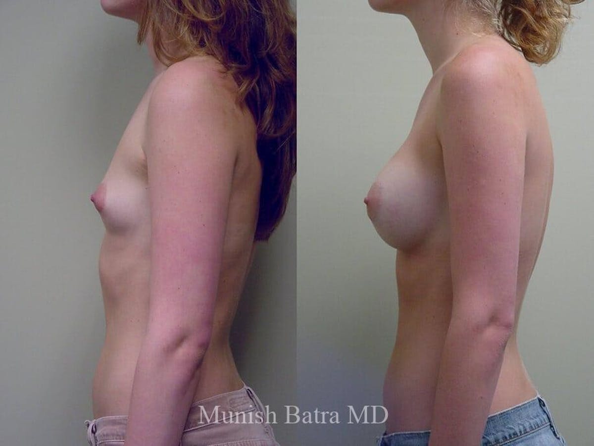 Breast Augmentation Before & After Gallery - Patient 224295 - Image 2