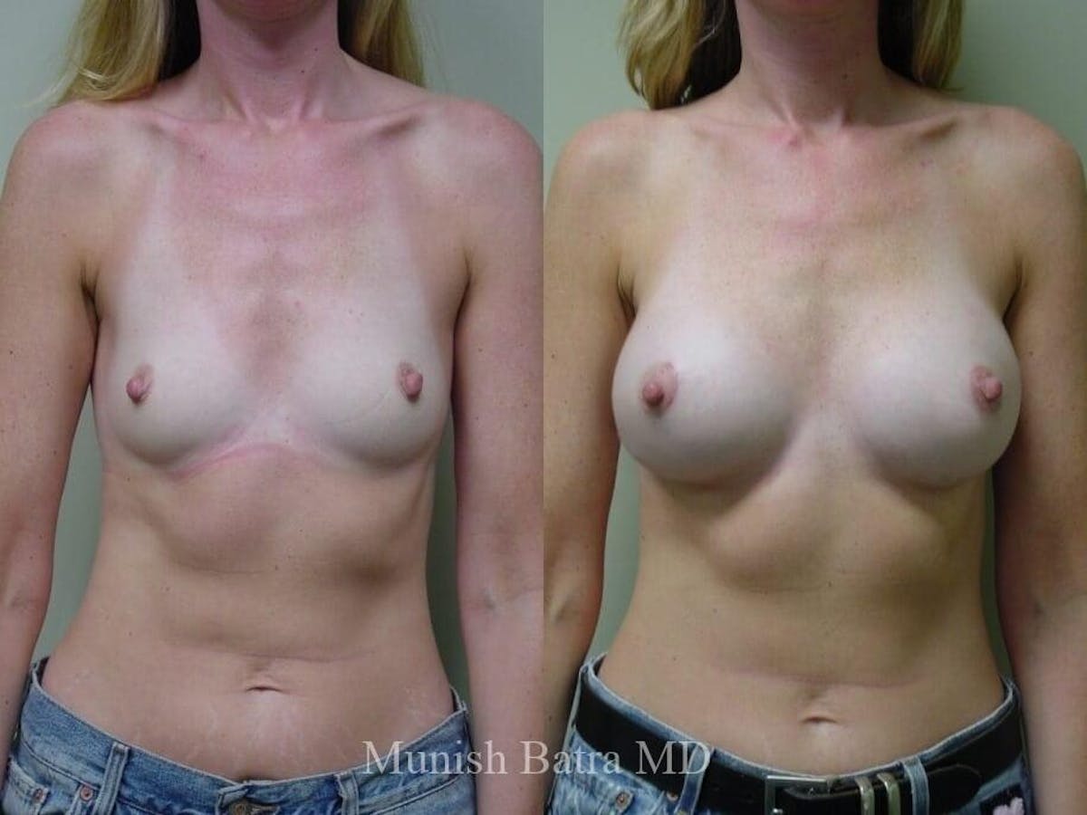Breast Augmentation Before & After Gallery - Patient 713748 - Image 1
