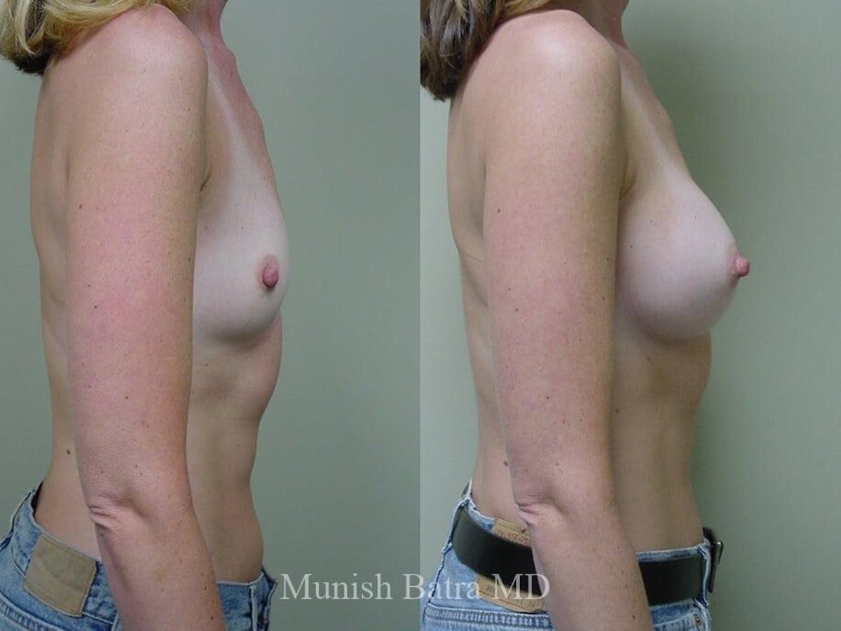 Breast Augmentation Before & After Gallery - Patient 713748 - Image 2