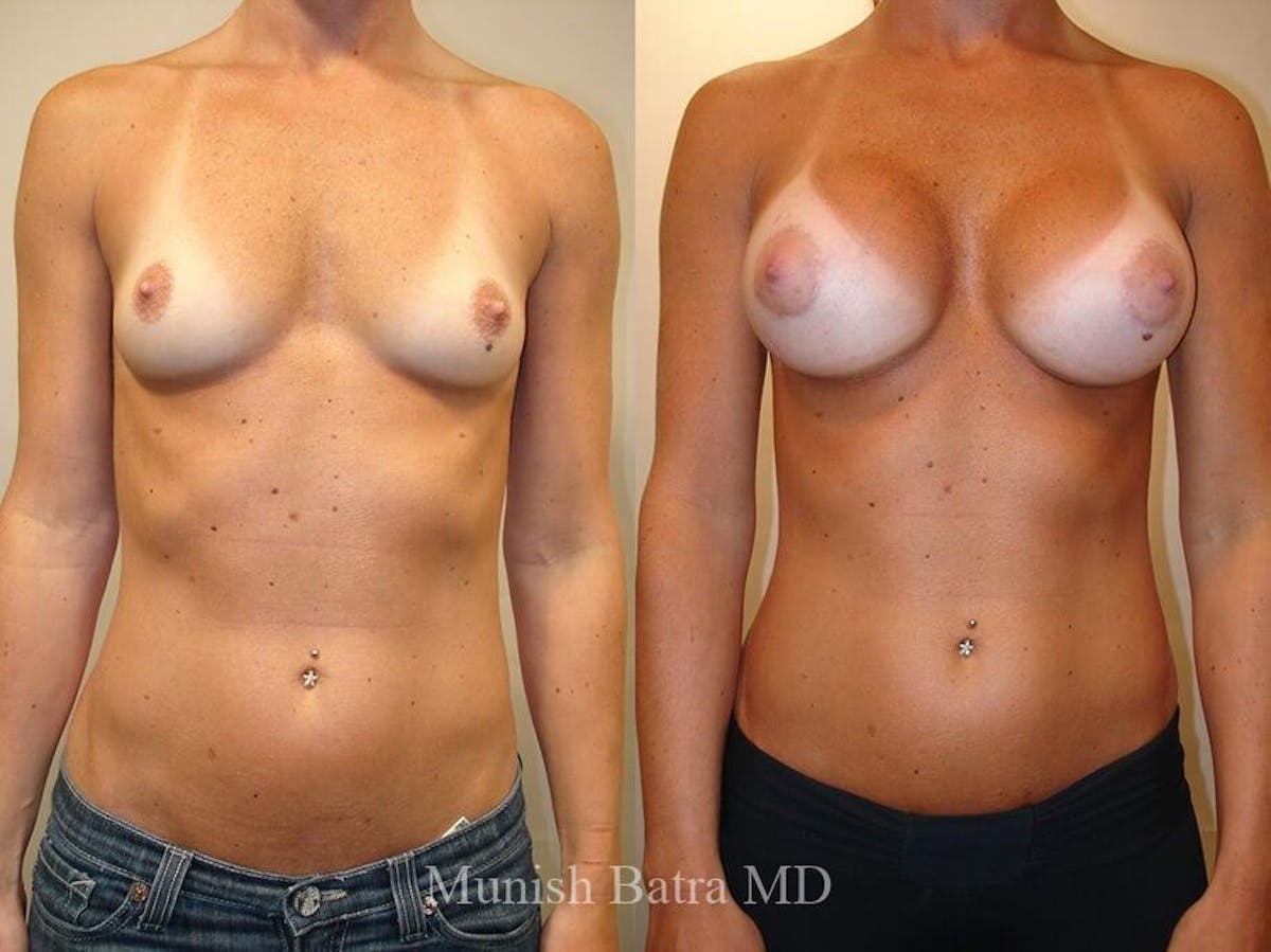 Breast Augmentation Before & After Gallery - Patient 396483 - Image 1
