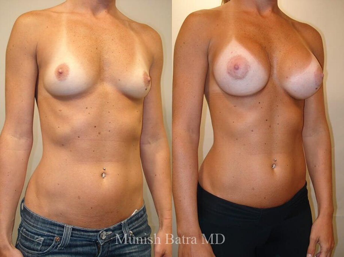 Breast Augmentation Before & After Gallery - Patient 396483 - Image 2