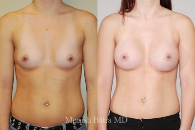 Breast Augmentation Before & After Gallery - Patient 142859 - Image 1