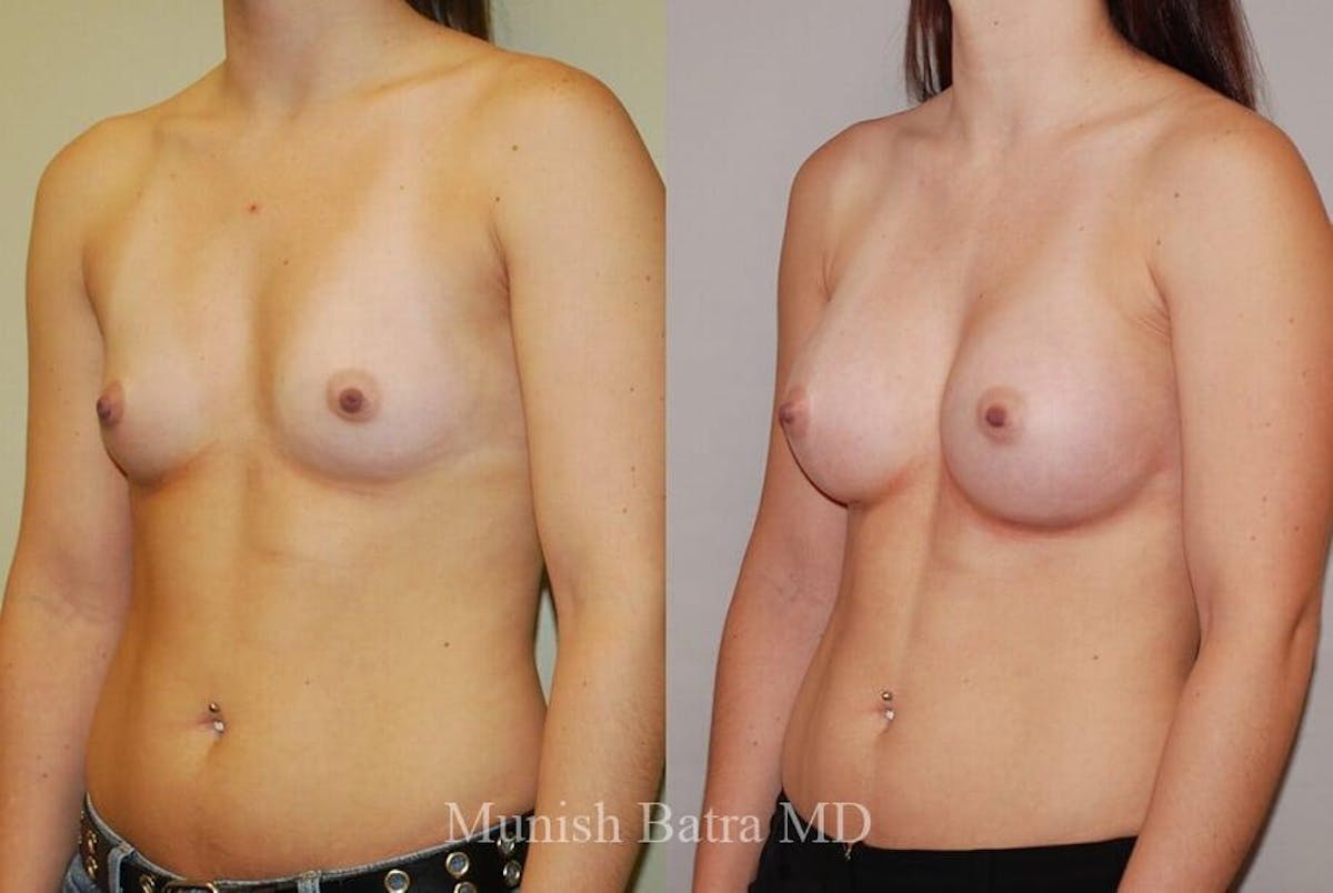 Breast Augmentation Before & After Gallery - Patient 142859 - Image 2