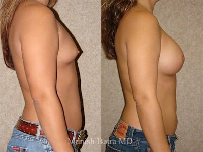 Breast Augmentation Before & After Gallery - Patient 117325 - Image 1