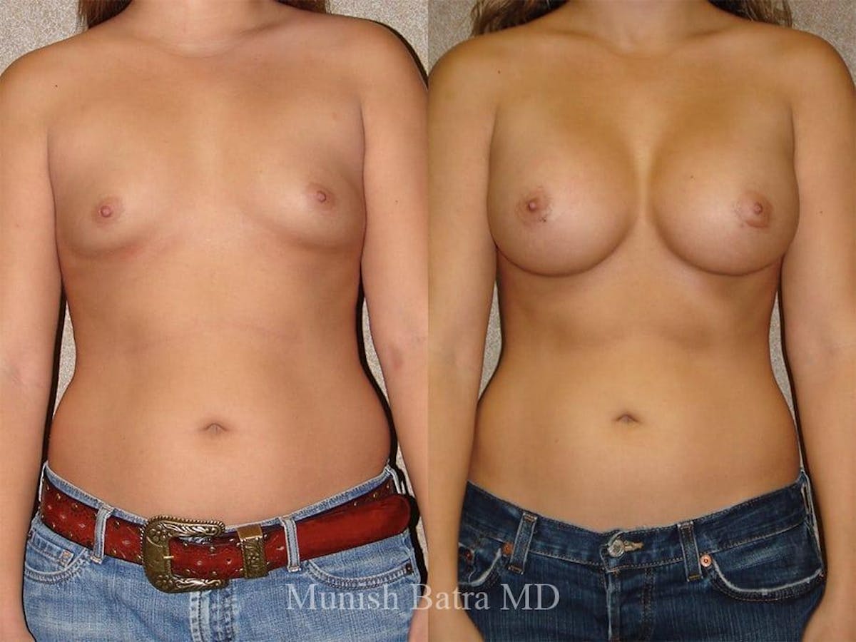Breast Augmentation Before & After Gallery - Patient 117325 - Image 2