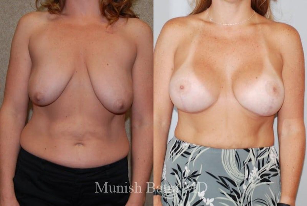 Breast Augmentation with Lift Mastopexy Before & After Gallery - Patient 478096 - Image 1